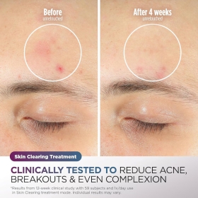 Shark FW312EUPL CryoGlow – masca faciala LED, cu lumina rosie/albastra si infrarosu, telecomanda